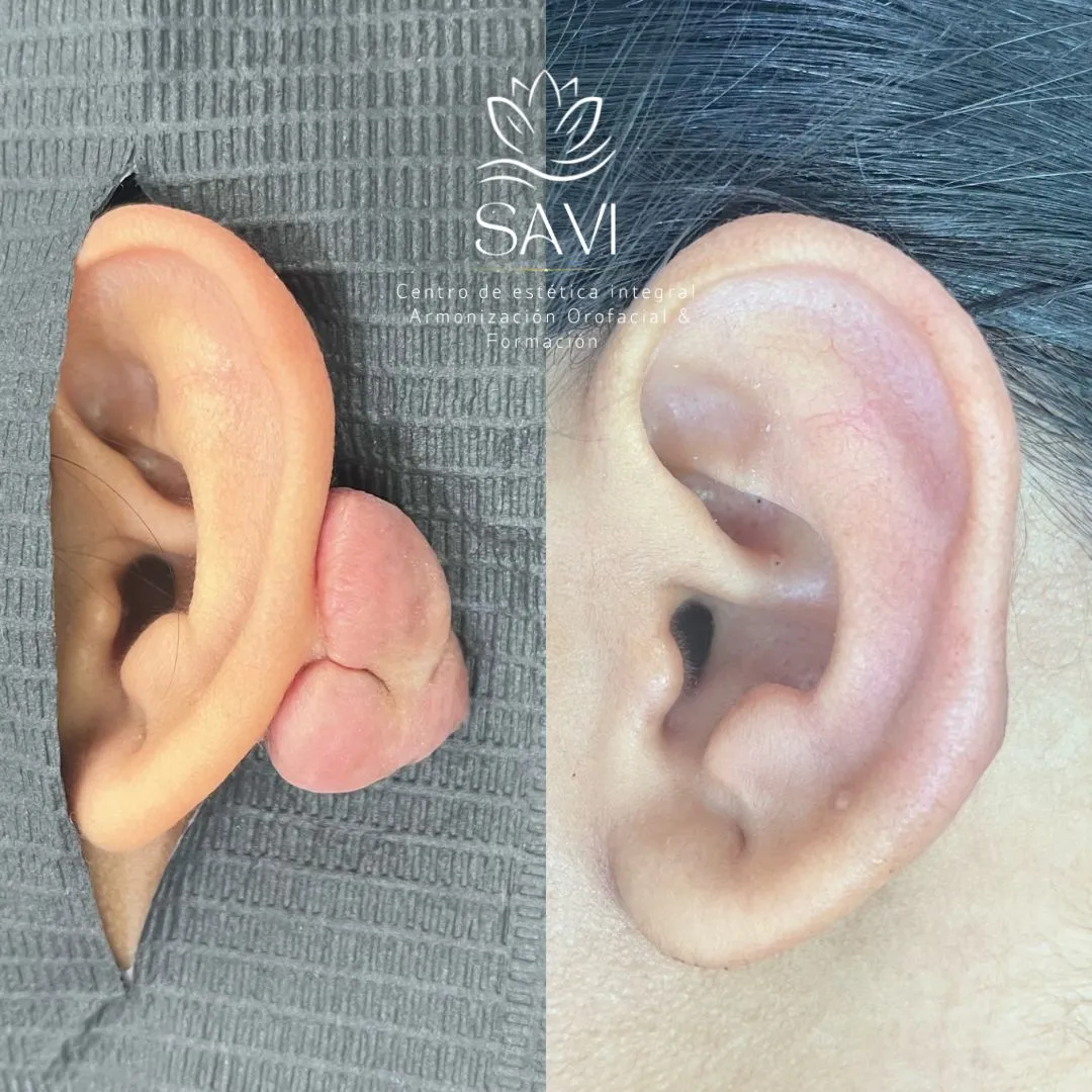 Remoción de queloide