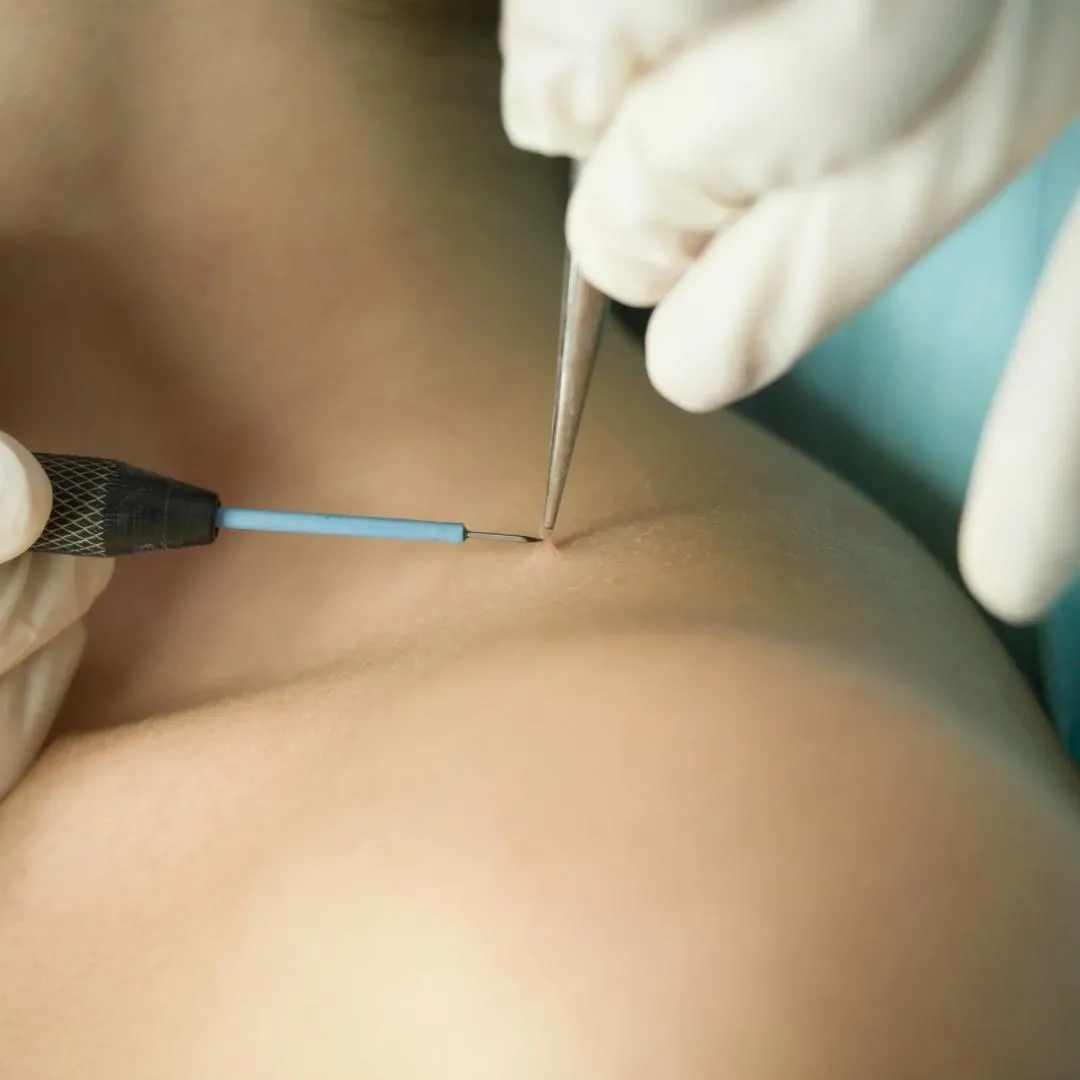 Remoción de verrugas