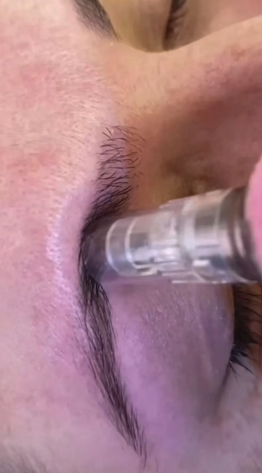 Regeneración y Recuperación de cejas - 1