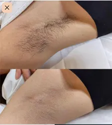 DEPILACION CON CERA EN AXILAS (HOMBRE) - 2