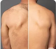 DEPILACION CON CERA EN ESPALDA (HOMBRE) - 2