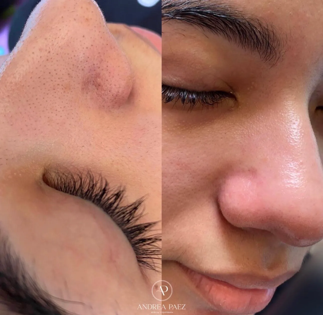 Higiene Facial para Adolescentes