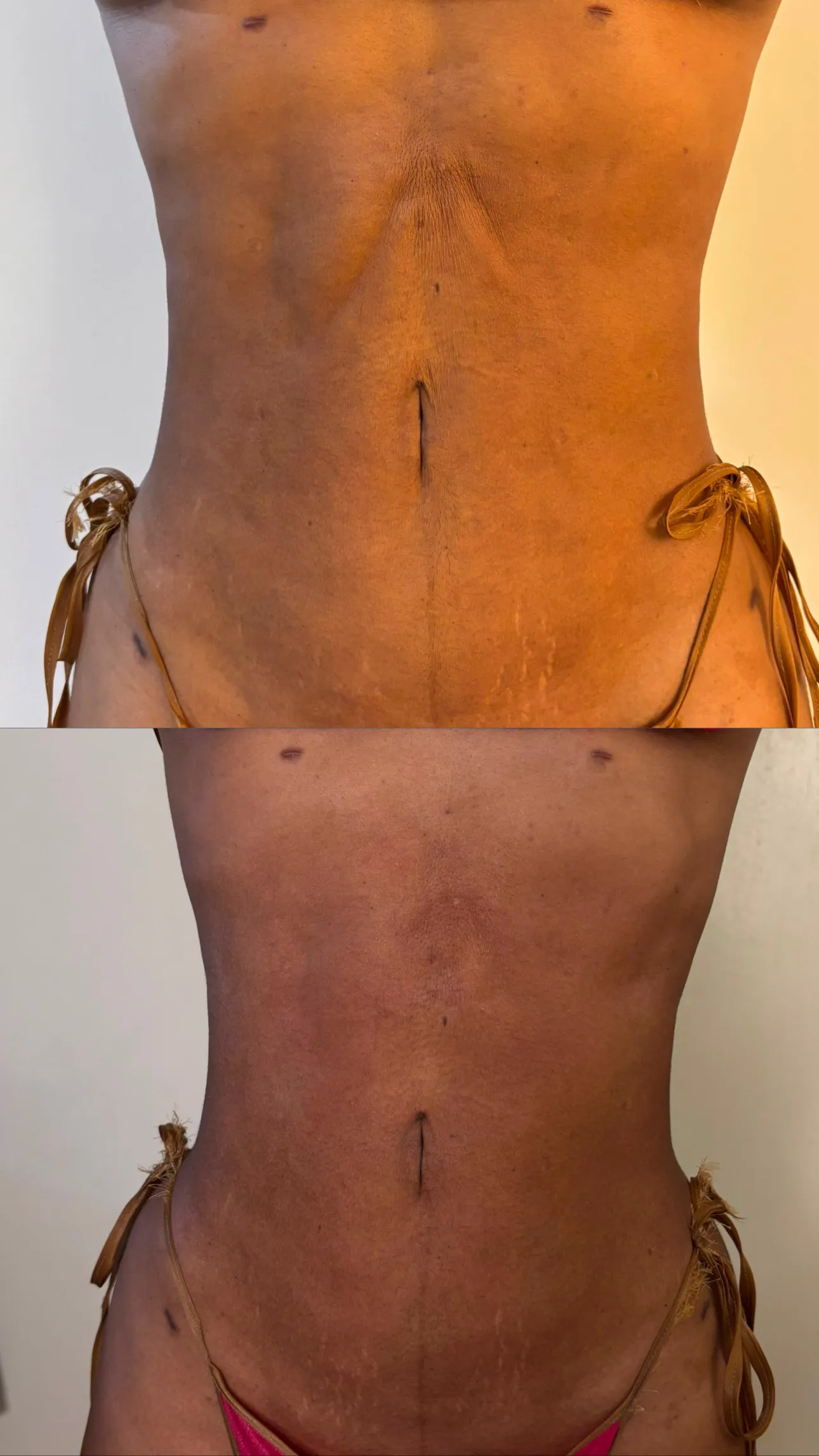 Fibrosis Recovery