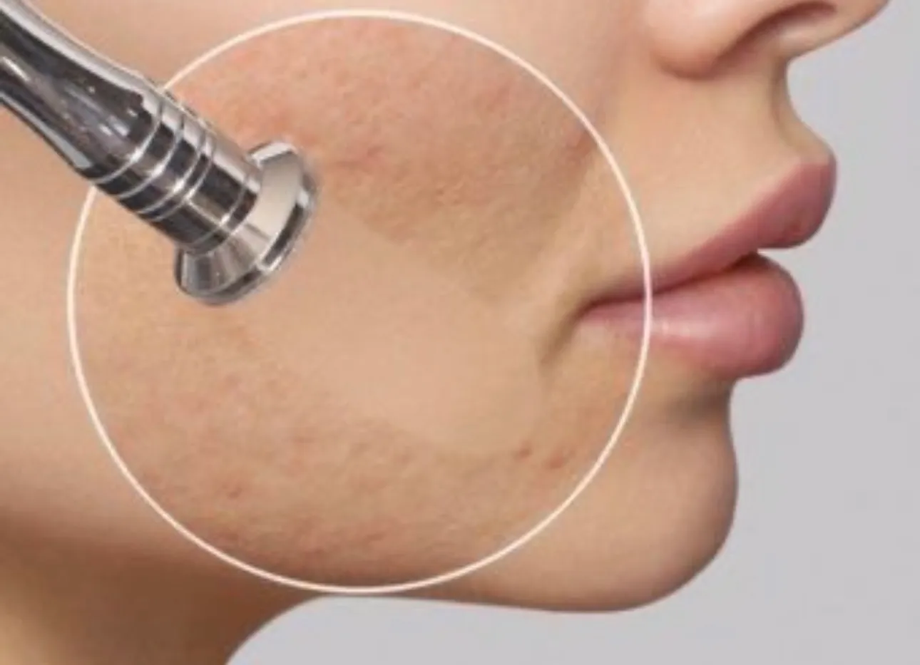 Higiene Facial Profunda + Microdermoabrasión