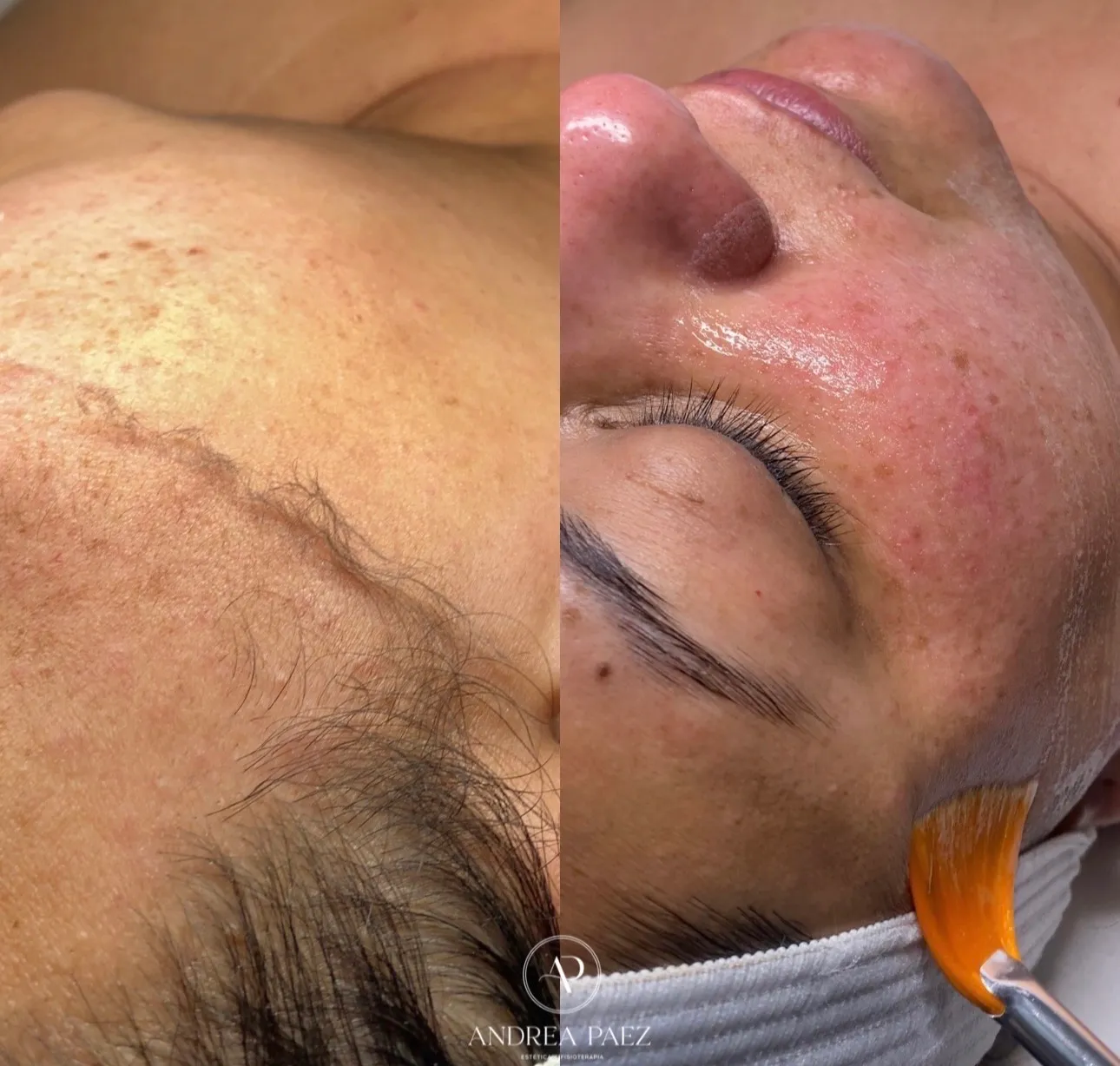 Dermaplaning