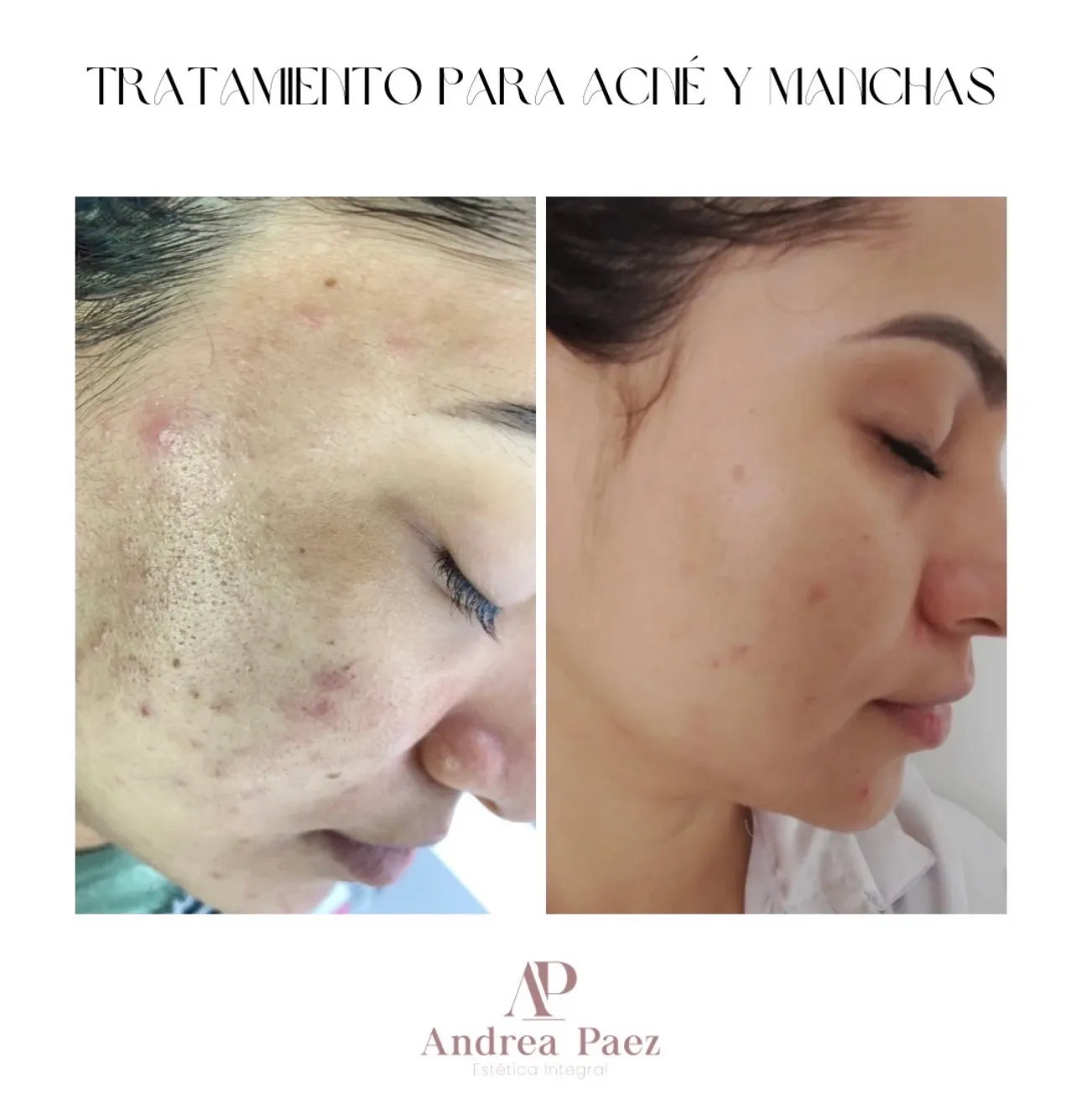 Higiene Facial Piel Acné
