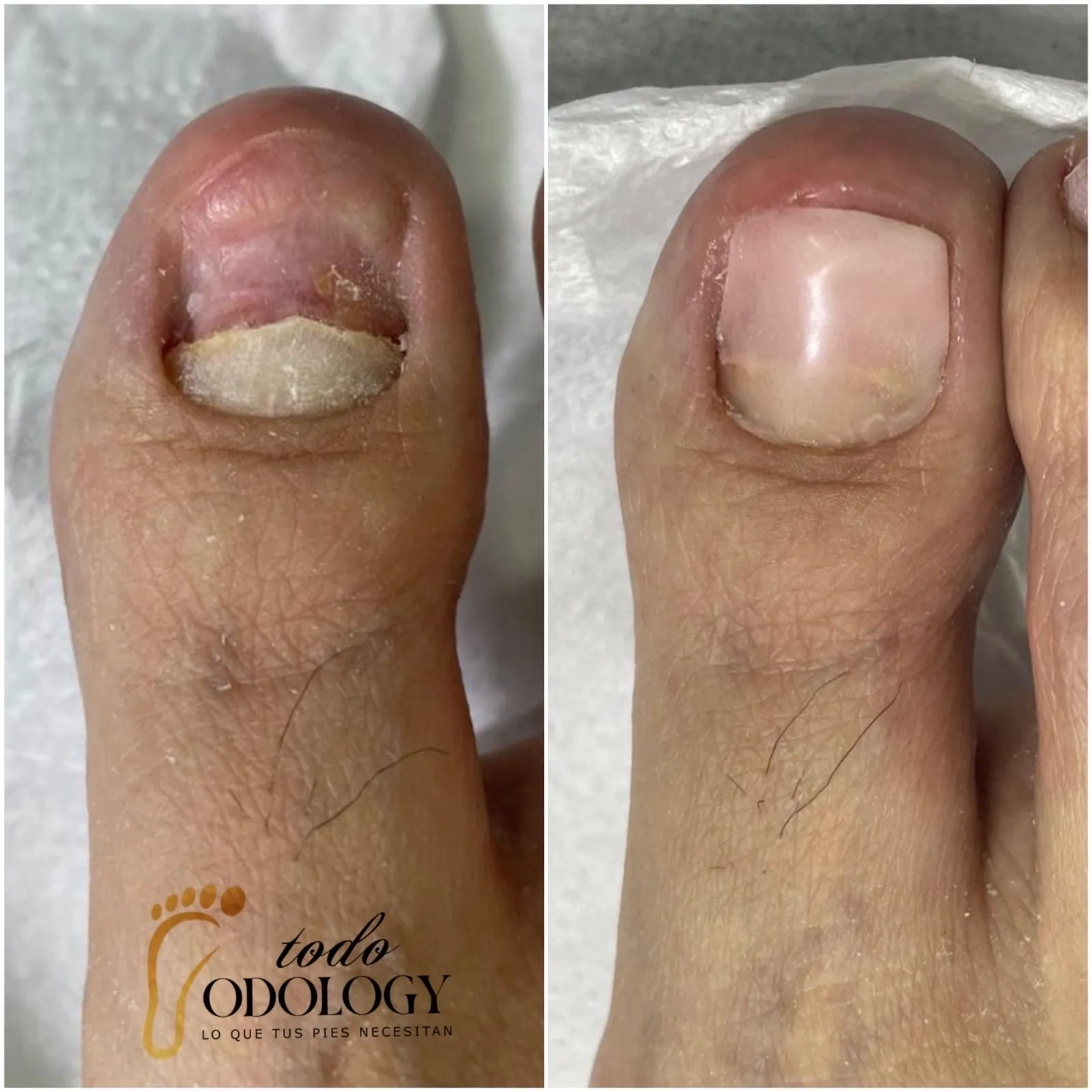 reconstrucción en ambos primeros ortejos (dedos gordos) - Imagen 1