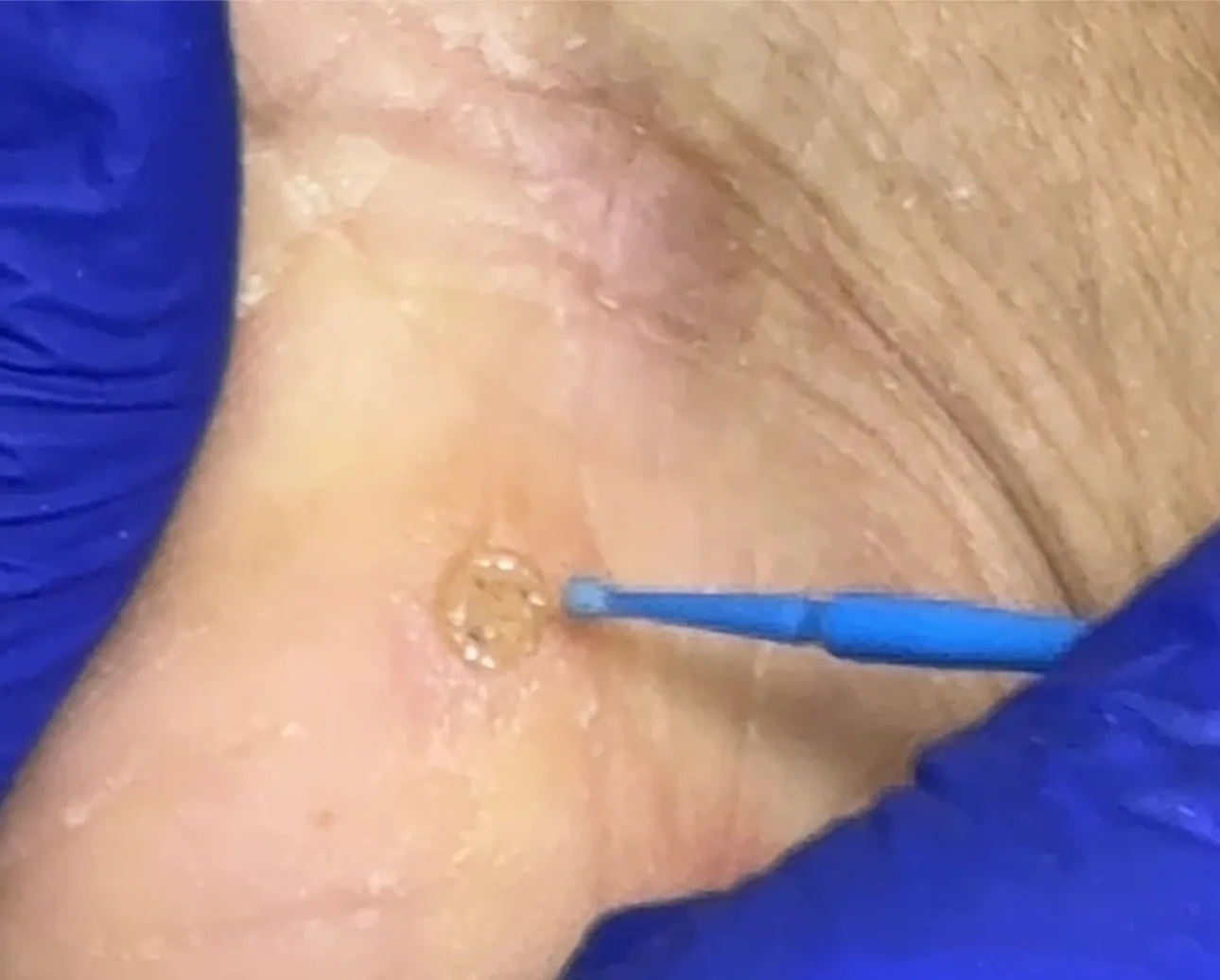 extracción de verruga 