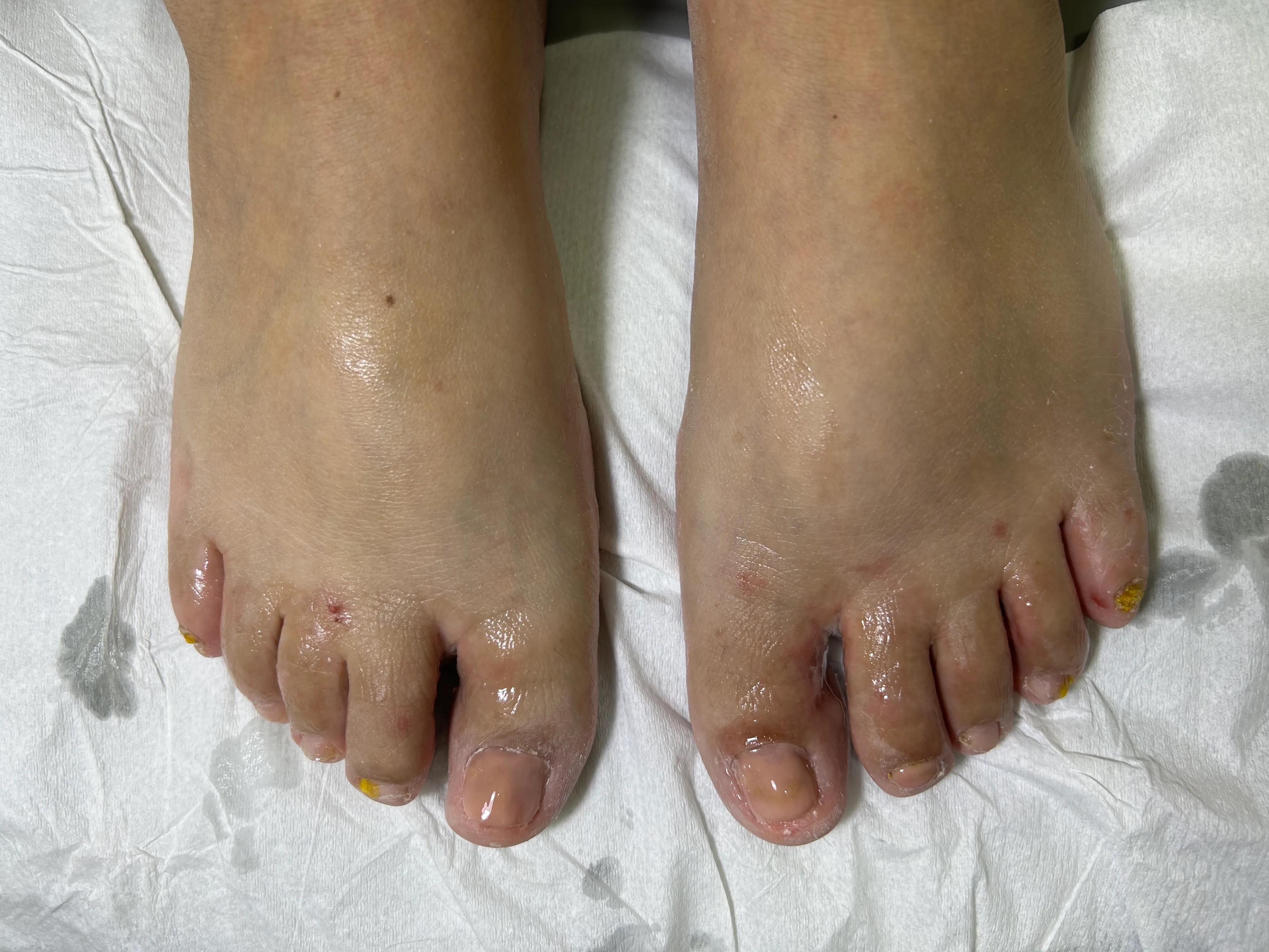 Podología más reconstrucción primer ortejo - Imagen 1