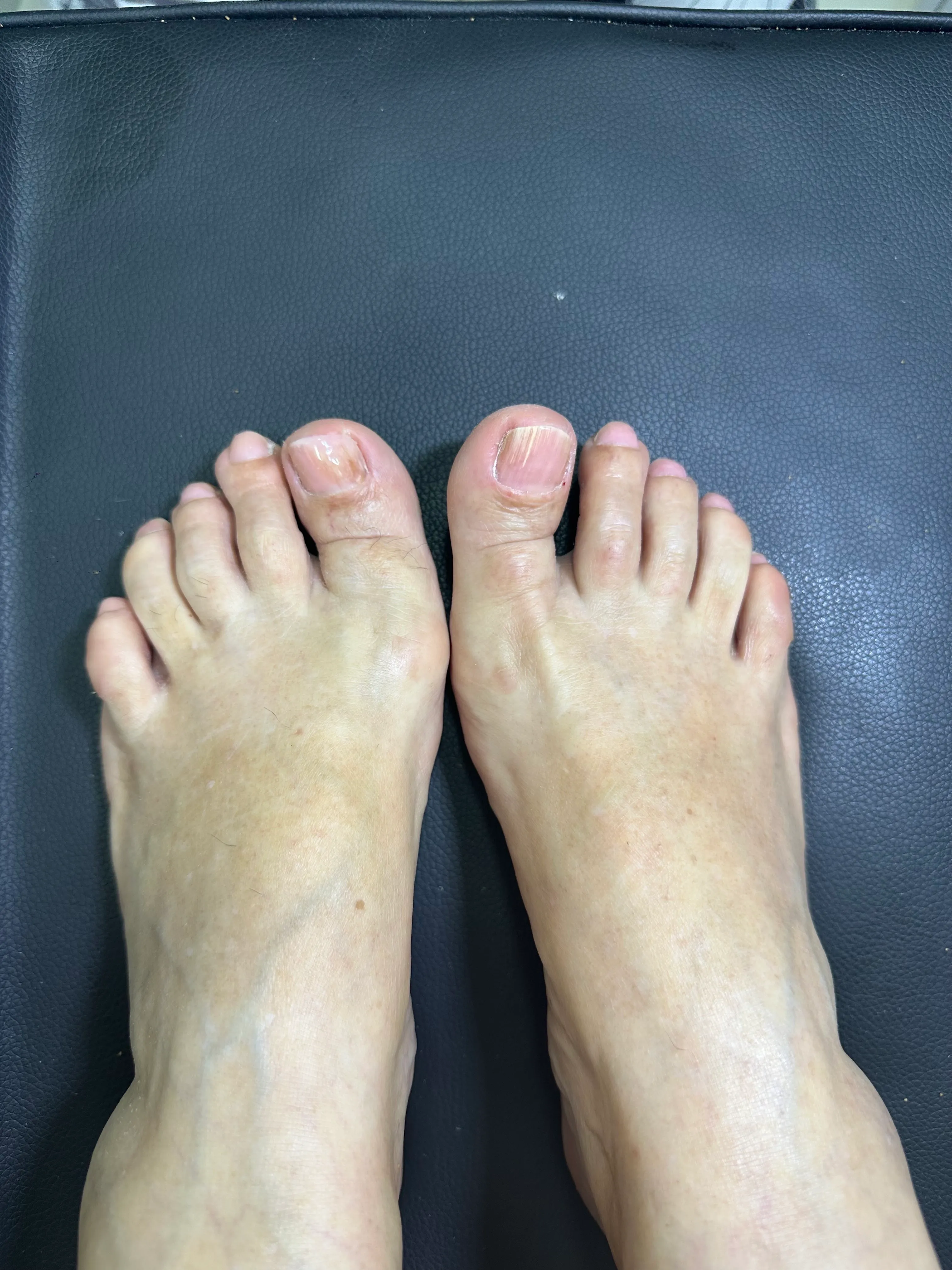 Reconstrucción primer ortejo (dedo gordo) - Imagen 1