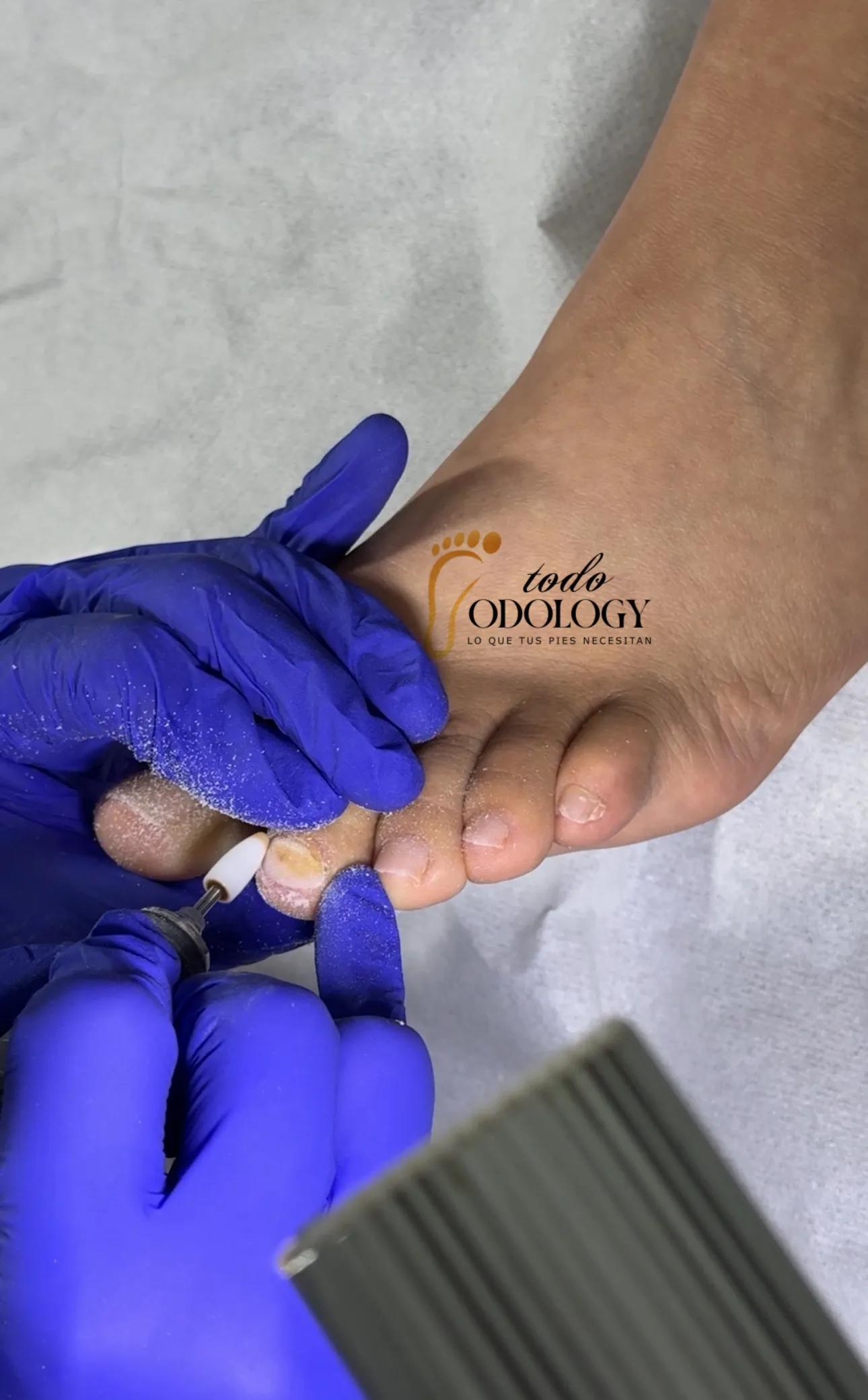 Reconstrucción dedos pequeños - Imagen 1