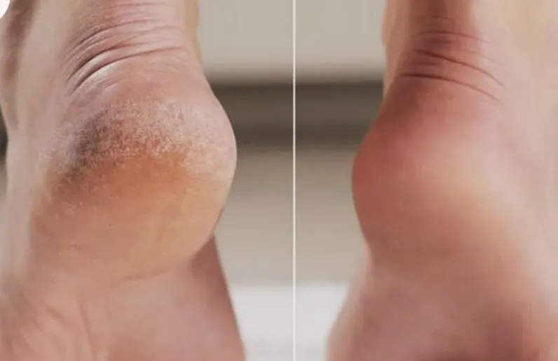 pies limpieza profunda