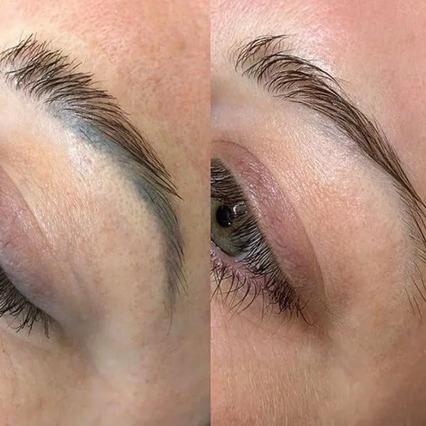Remoción Laser en cejas 1 sesión - Imagen 1