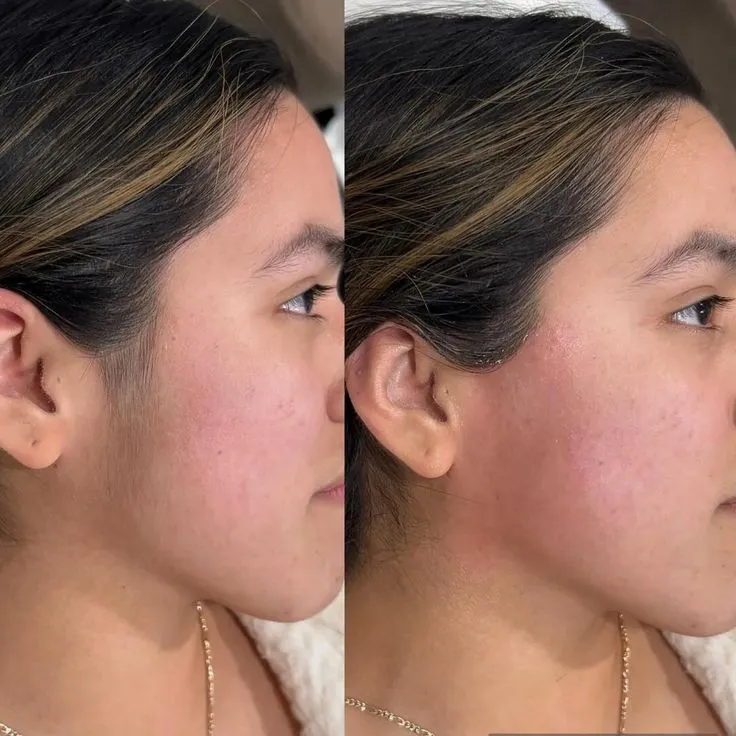 Epilación de Patillas