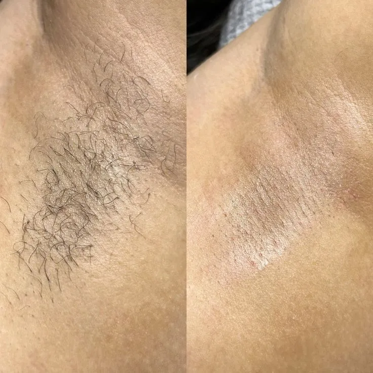 Epilación de Axilas