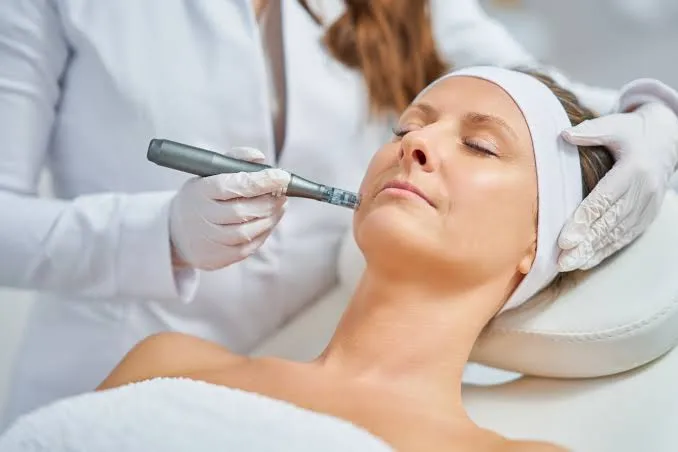 Microneedling con células madre y PDRN
