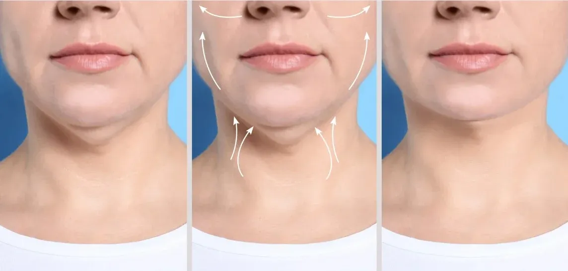 6 sesiones de V-shape- avanzado tratamiento papada