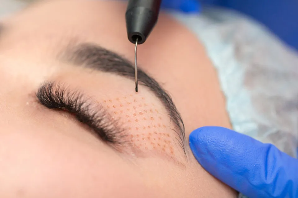 Fibroblats facial